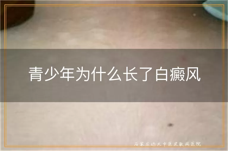 青少年为什么长了白癜风