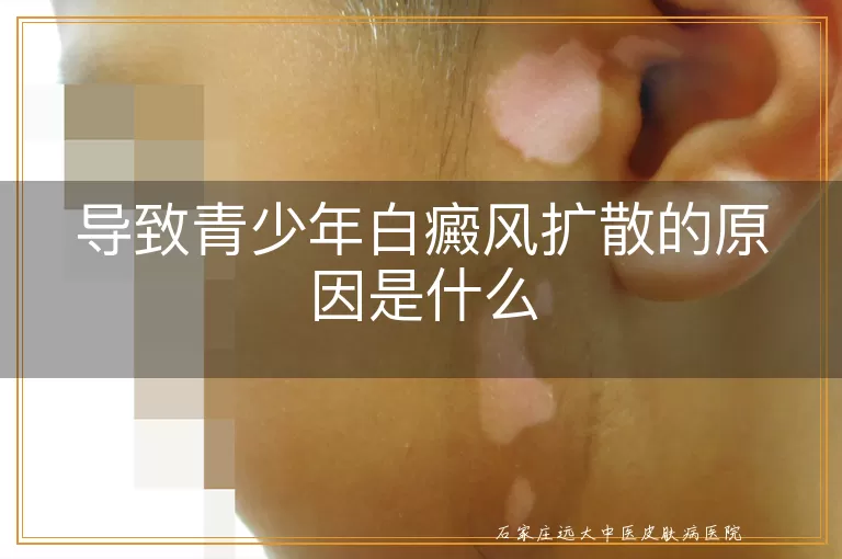 导致青少年白癜风扩散的原因是什么