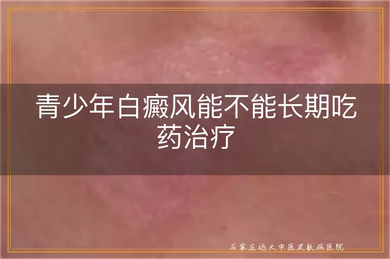 青少年白癜风能不能长期吃药治疗