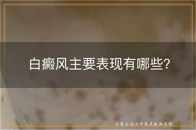 白癜风主要表现有哪些？