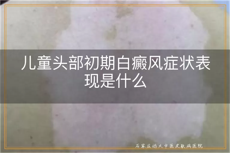 儿童头部初期白癜风症状表现是什么