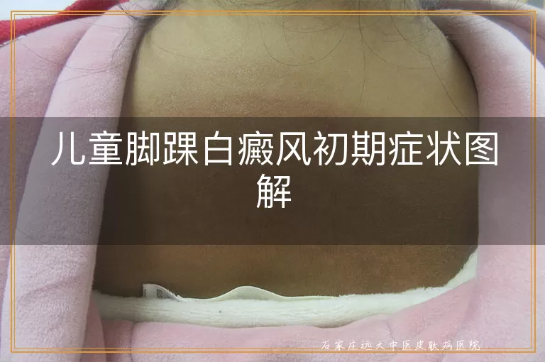 儿童脚踝白癜风初期症状图解