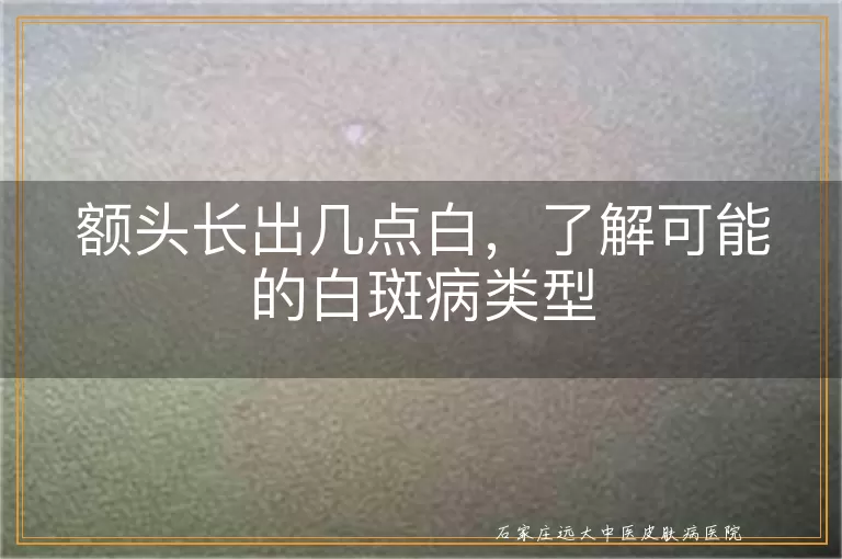 额头长出几点白，了解可能的白斑病类型
