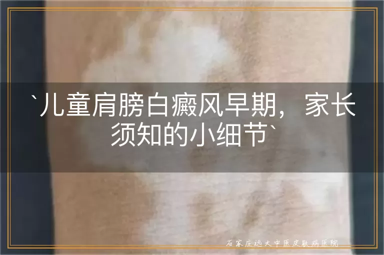 儿童肩膀白癜风早期,家长须知的小细节