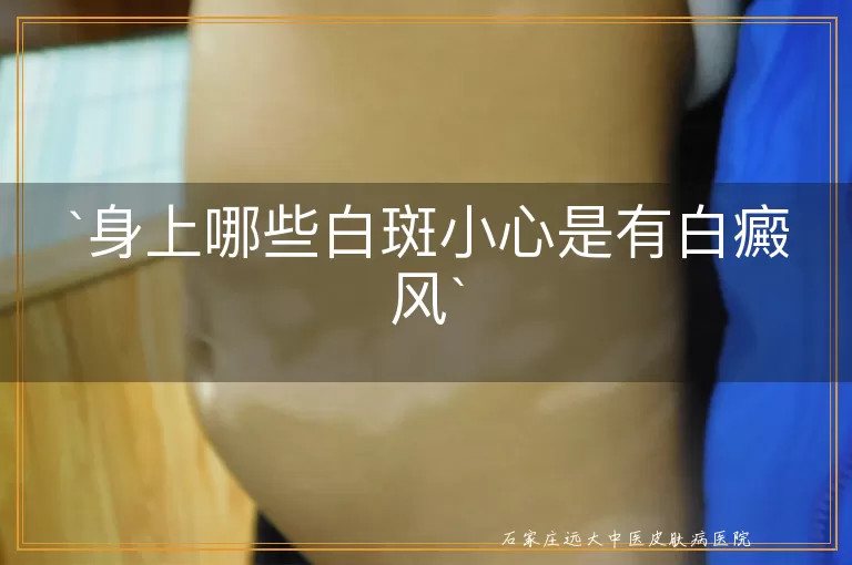 身上哪些白斑小心是有白癜风