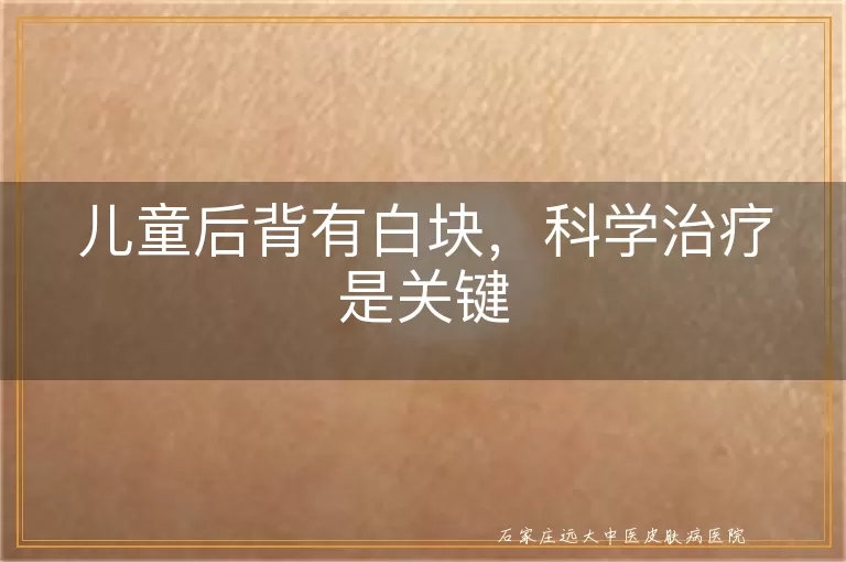 儿童后背有白块,科学治疗是关键
