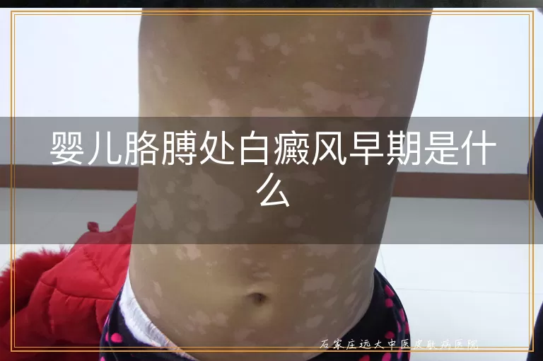 婴儿胳膊处白癜风早期是什么