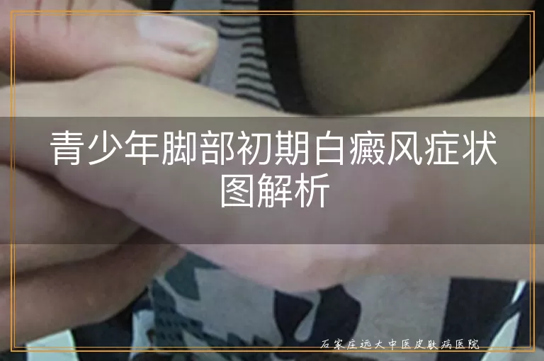青少年脚部初期白癜风症状图解析