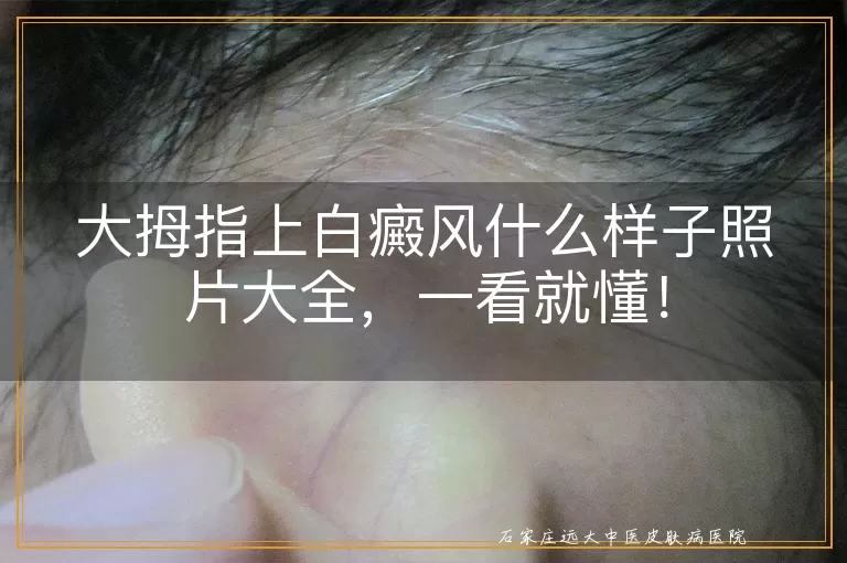 大拇指上白癜风什么样子照片大全，一看就懂！