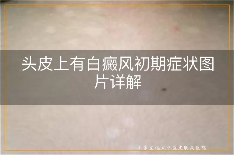 头皮上有白癜风初期症状图片详解
