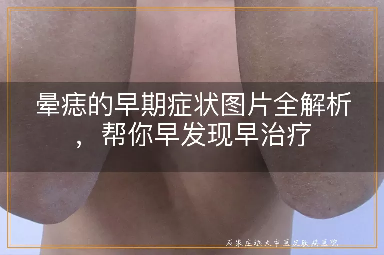 晕痣的早期症状图片全解析，帮你早发现早治疗