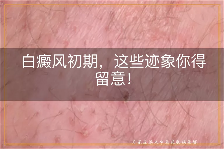 白癜风初期，这些迹象你得留意！