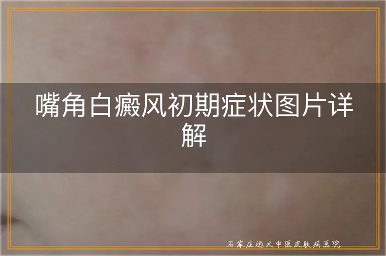 嘴角白癜风初期症状图片详解