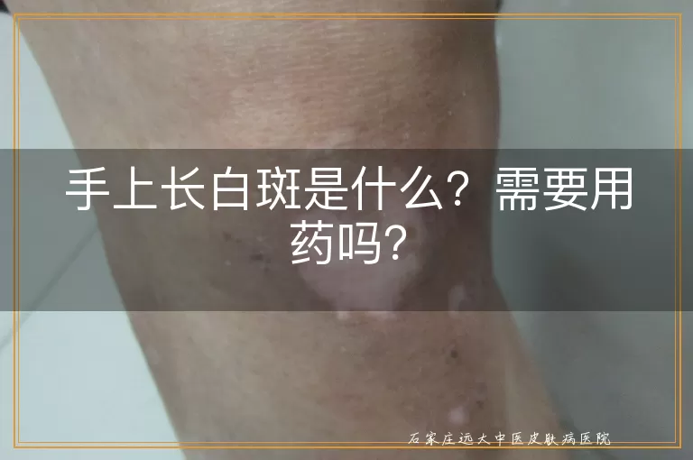 手上长白斑是什么？需要用药吗？