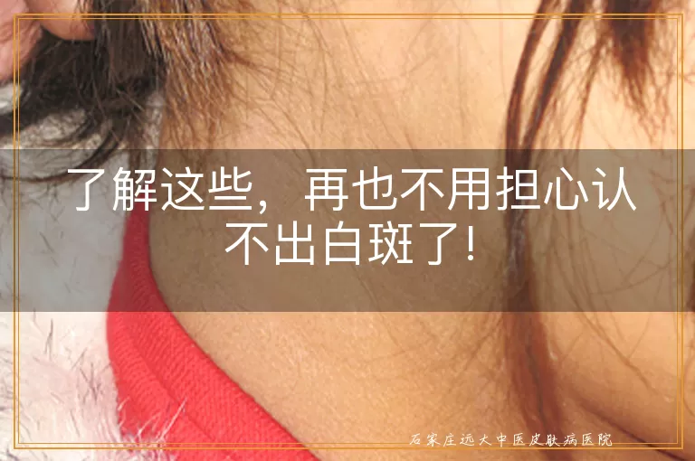了解这些，再也不用担心认不出白斑了!