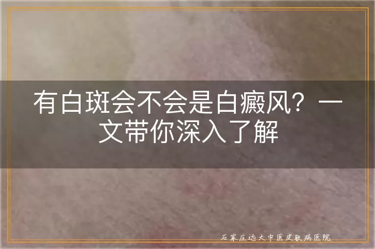 有白斑会不会是白癜风？一文带你深入了解