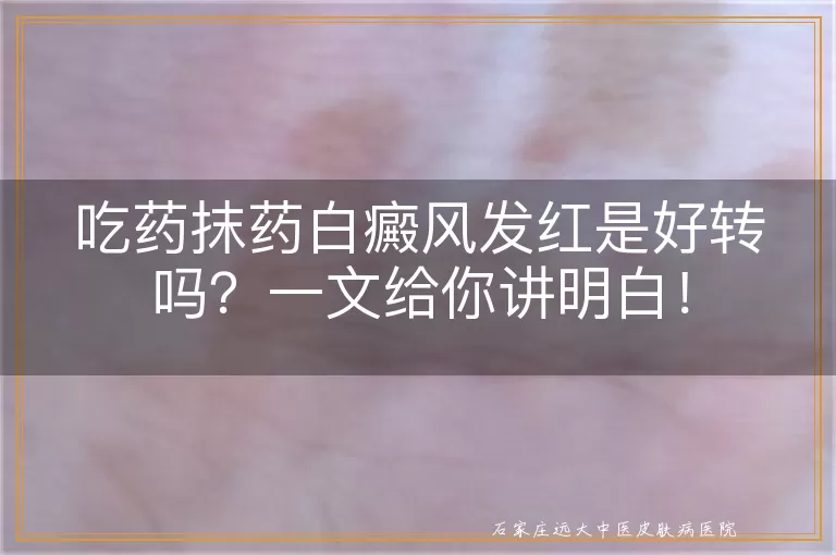 吃药抹药白癜风发红是好转吗？一文给你讲明白！