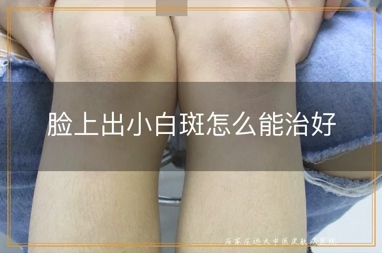 脸上出小白斑怎么能治好