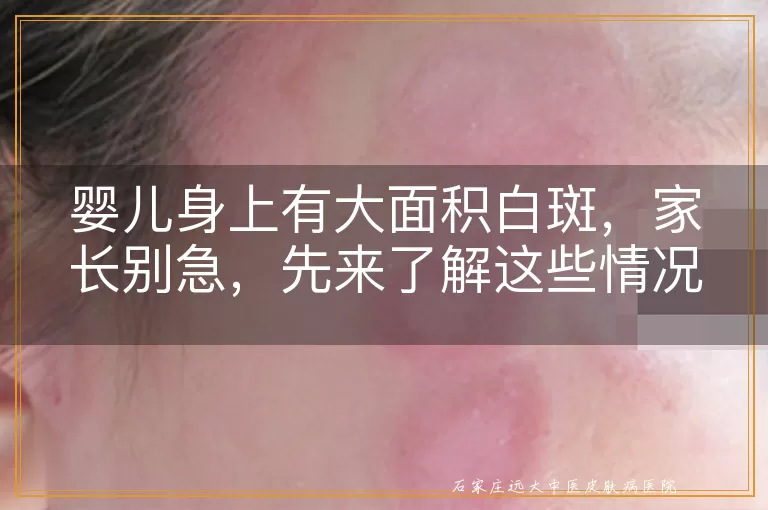 婴儿身上有大面积白斑，家长别急，先来了解这些情况与治疗方法