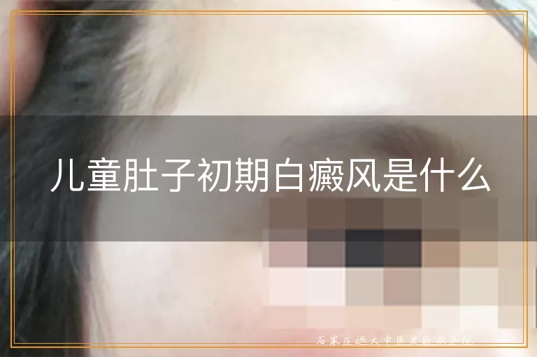 儿童肚子初期白癜风是什么
