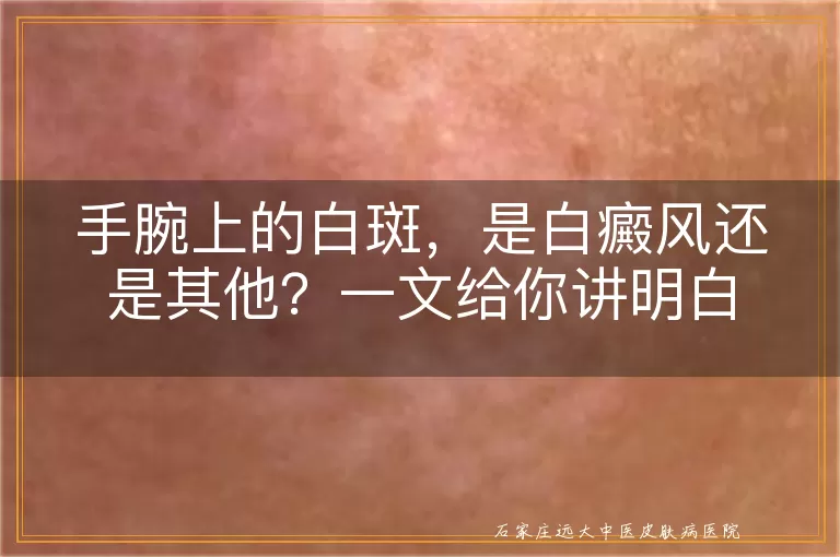 手腕上的白斑，是白癜风还是其他？一文给你讲明白