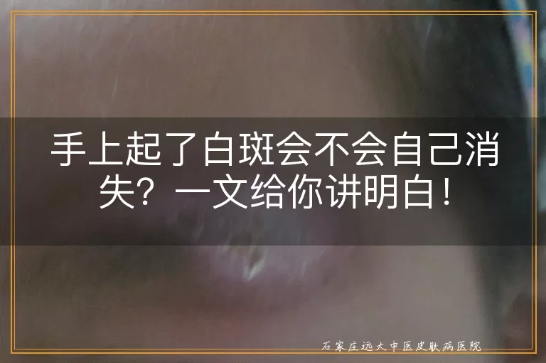 手上起了白斑会不会自己消失？一文给你讲明白！