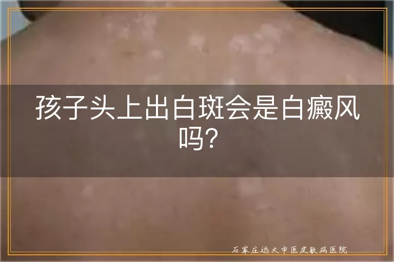 孩子头上出白斑会是白癜风吗？