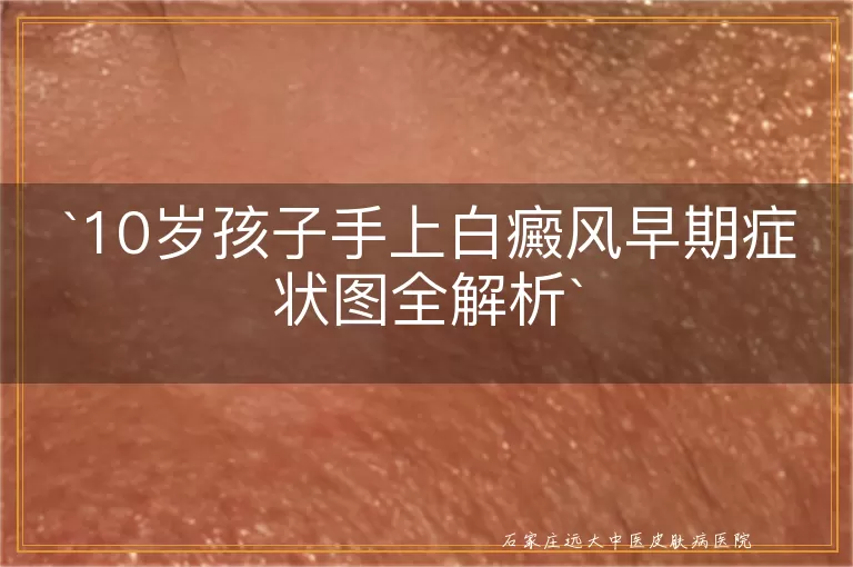10岁孩子手上白癜风早期症状图全解析