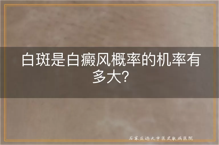 白斑是白癜风概率的机率有多大？