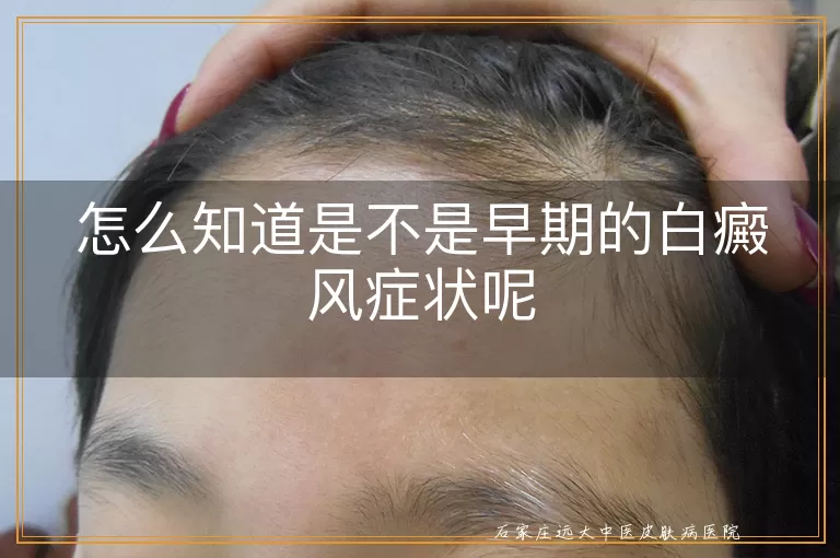 怎么知道是不是早期的白癜风症状呢