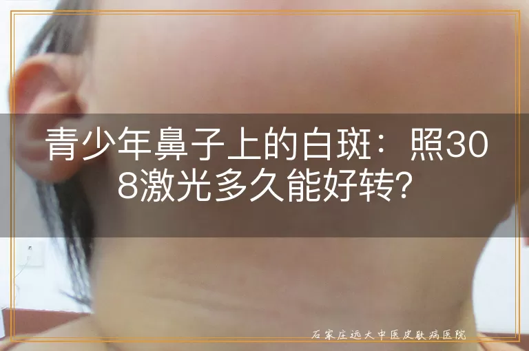 青少年鼻子上的白斑：照308激光多久能好转？