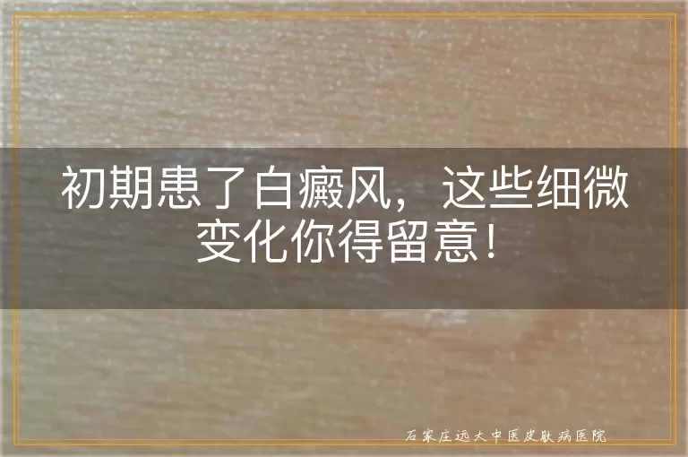 初期患了白癜风，这些细微变化你得留意！