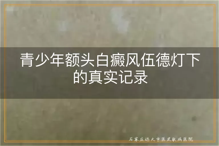 青少年额头白癜风伍德灯下的真实记录
