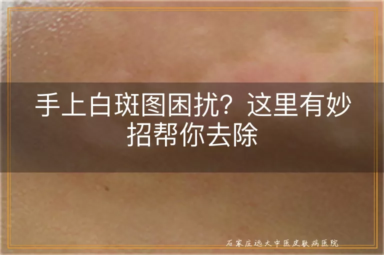 手上白斑图困扰？这里有妙招帮你去除
