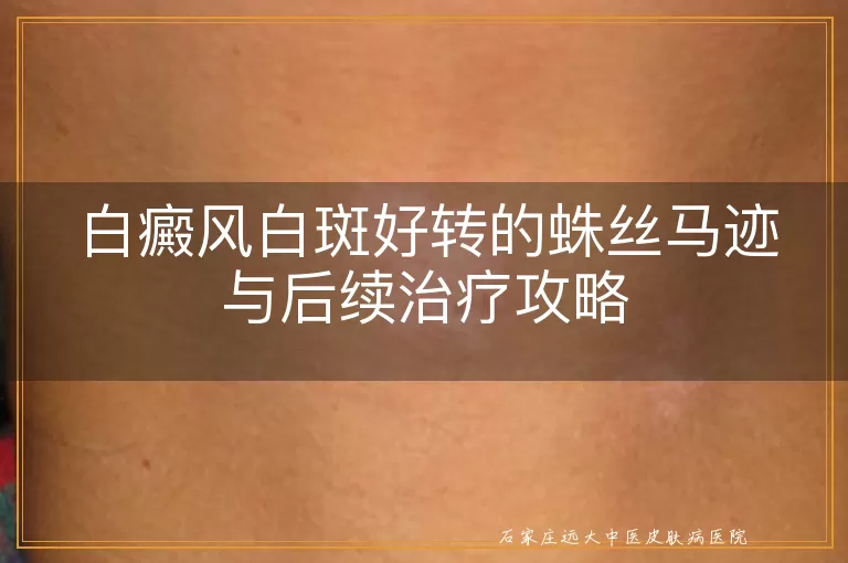 白癜风白斑好转的蛛丝马迹与后续治疗攻略