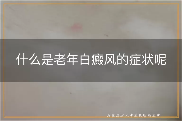 什么是老年白癜风的症状呢