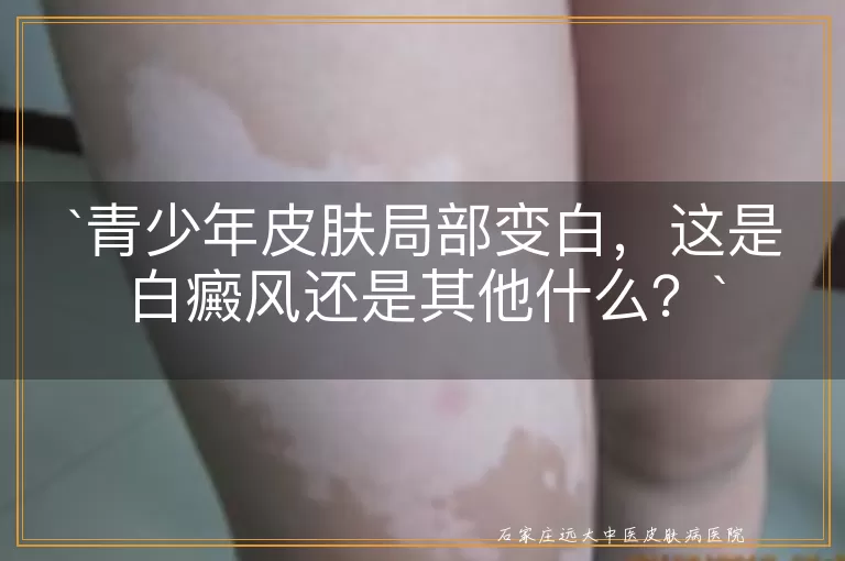 青少年皮肤局部变白，这是白癜风还是其他什么？