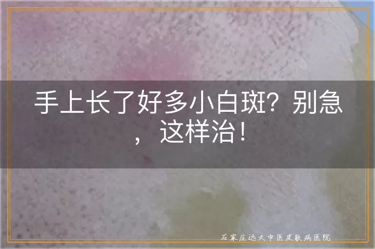 手上长了好多小白斑？别急，这样治！