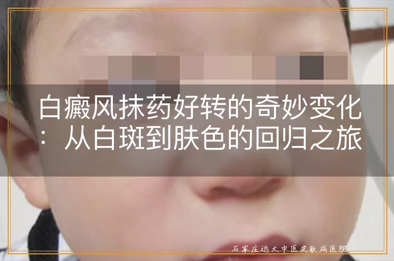 白癜风抹药好转的奇妙变化：从白斑到肤色的回归之旅