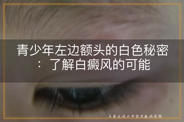 青少年左边额头的白色秘密：了解白癜风的可能