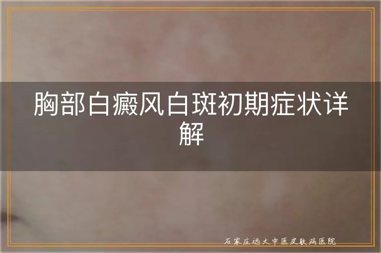 胸部白癜风白斑初期症状详解