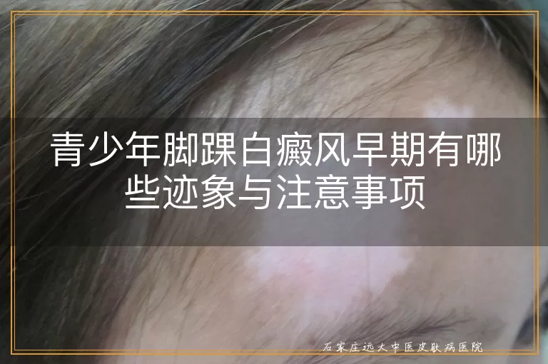 青少年脚踝白癜风早期有哪些迹象与注意事项
