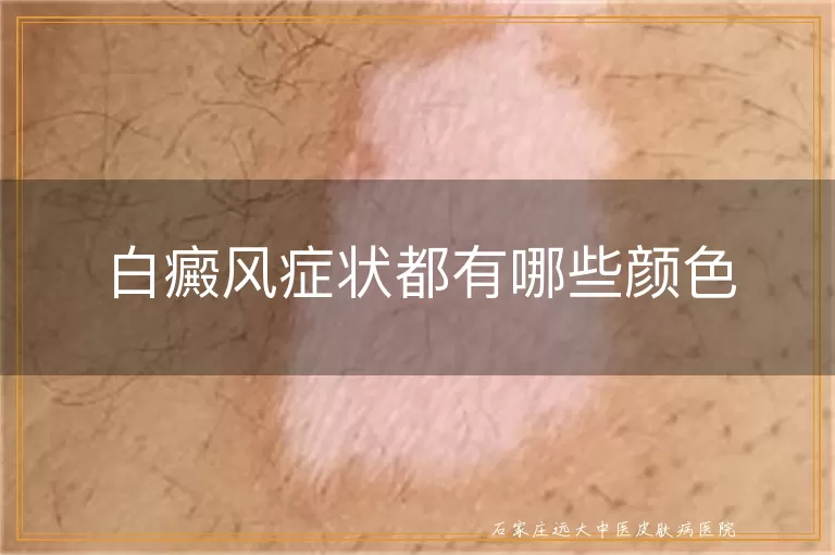 白癜风症状都有哪些颜色