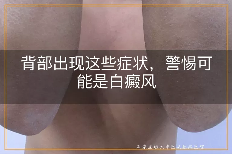 背部出现这些症状,警惕可能是白癜风