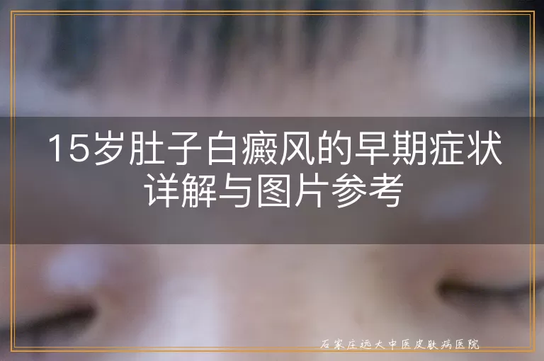 15岁肚子白癜风的早期症状详解与图片参考