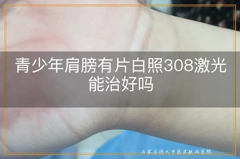 青少年肩膀有片白照308激光能治好吗