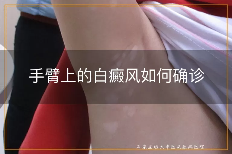 手臂上的白癜风如何确诊