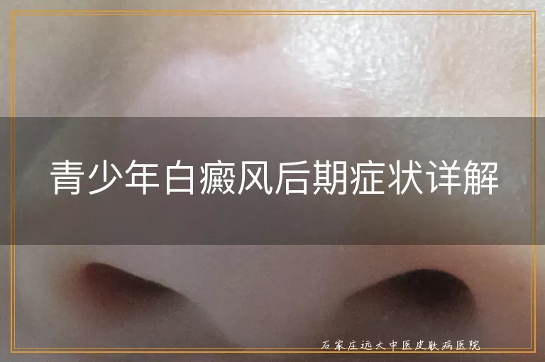 青少年白癜风后期症状详解