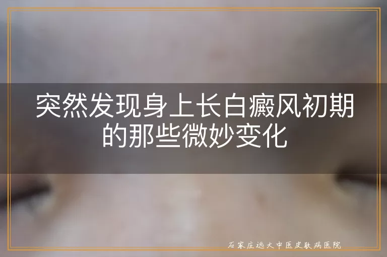 突然发现身上长白癜风初期的那些微妙变化