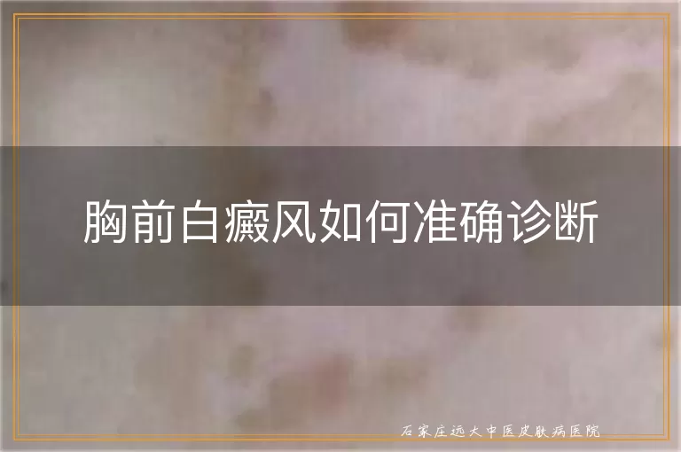胸前白癜风如何准确诊断